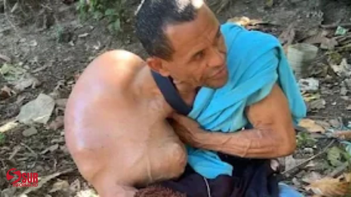Hombre clama desesperadamente por ayuda médica urgente tras ser diagnosticado con tumor en el hombro